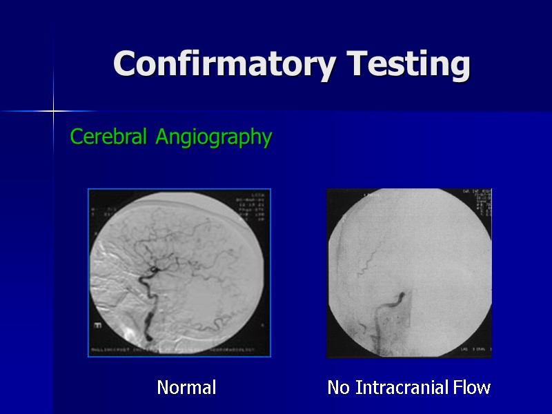 Confirmatory Testing Cerebral Angiography Normal No Intracranial Flow